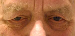 Dermatochalasis web