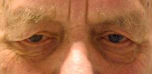 Dermatochalasis web